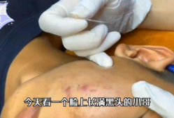 去黑头视频,告别毛孔烦恼——跟随视频教程学技巧